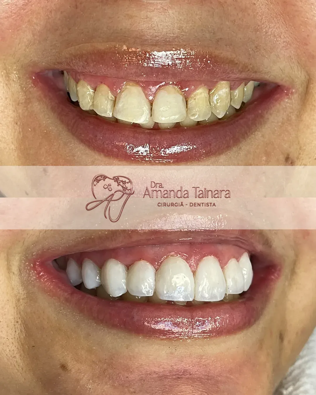 Antes e depois de correção de forma e cor dos dentes superiores com facetas em resina