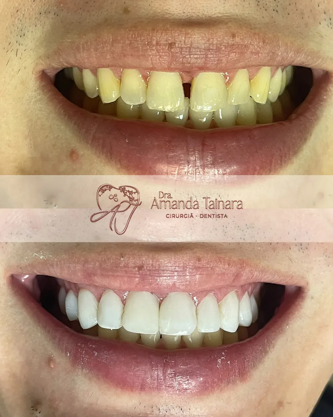 Antes e depois de facetas em resina com fechamento de espaço entre os dentes superiores