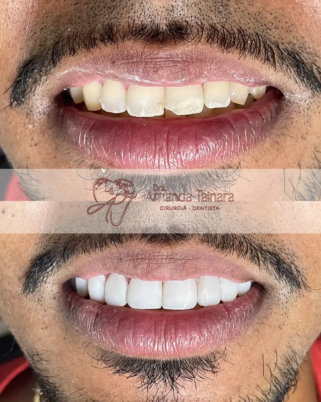 Antes e depois de facetas em resina nos dentes superiores de um paciente