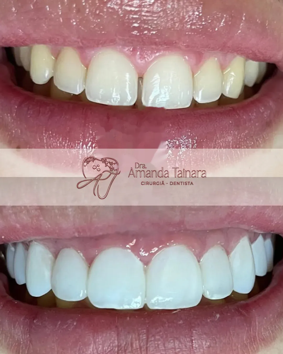 Antes e depois de facetas em resina nos dentes superiores, em close do sorriso
