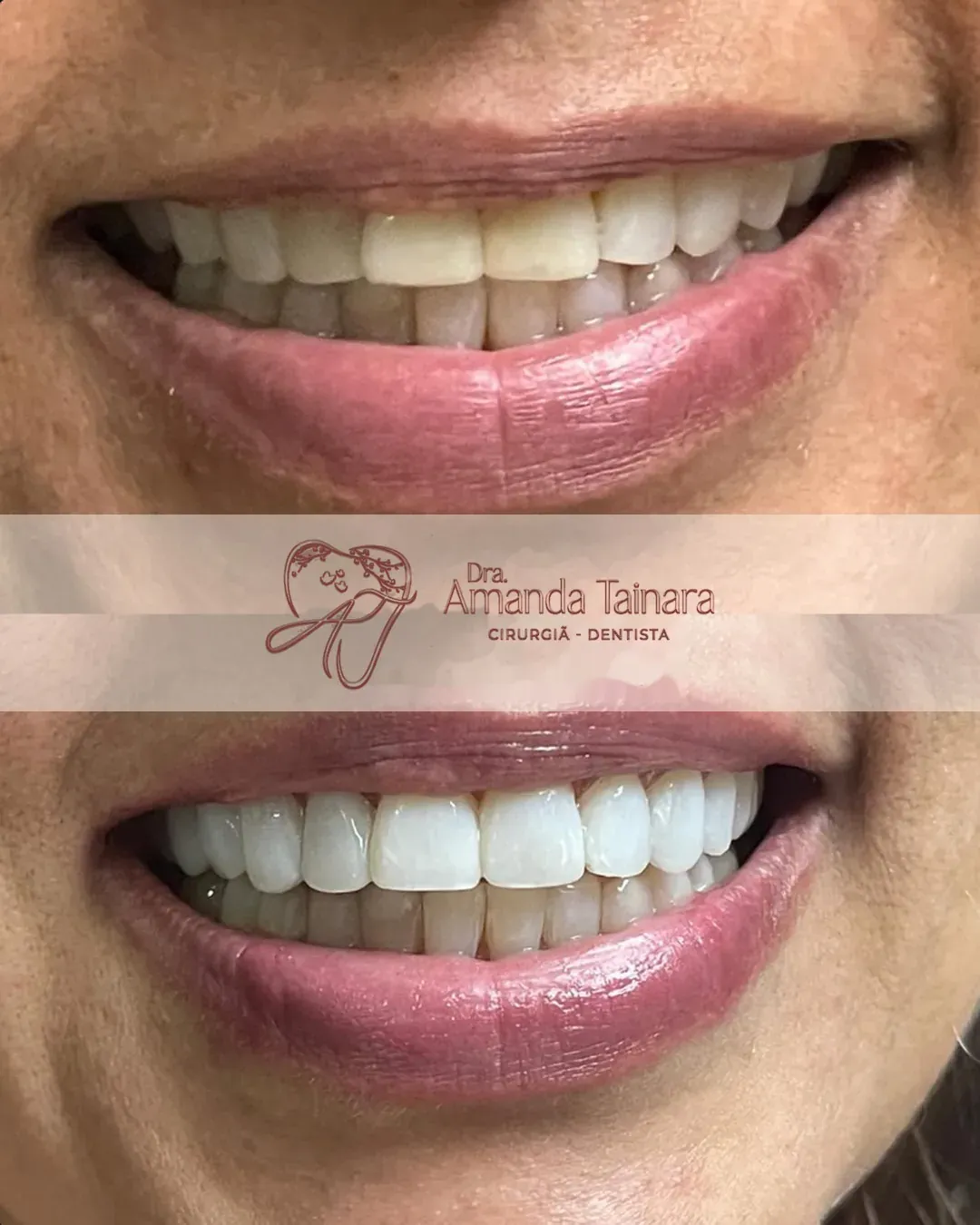 Antes e depois de facetas em resina nos dentes superiores de uma paciente, em close do sorriso